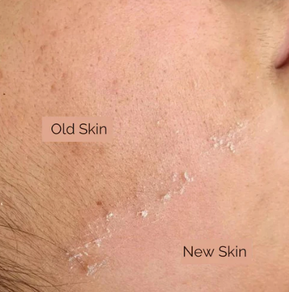 Dermaplaning for Anti-Ageing: How It Works and What to Expect