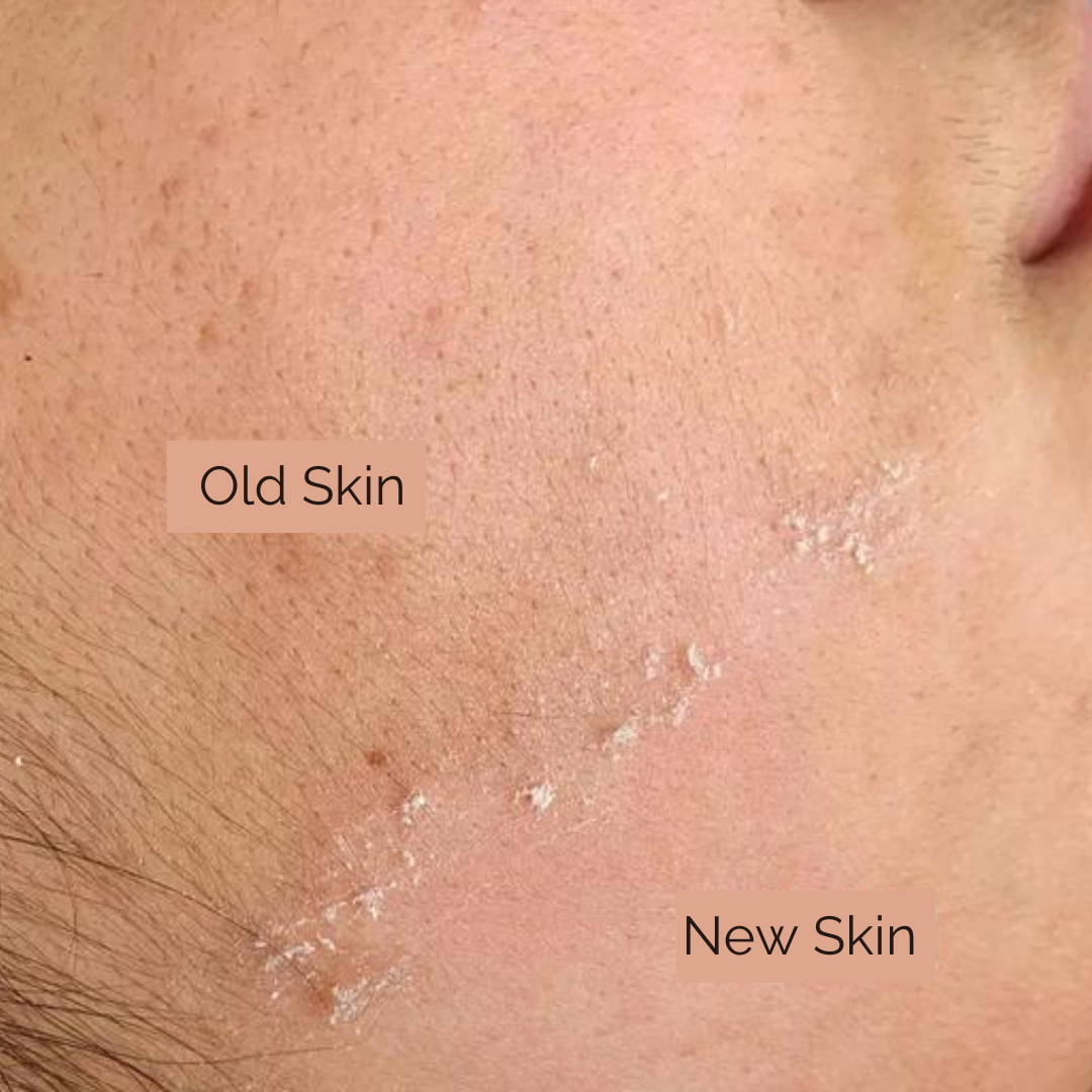 Close up of the skin on the face with Old skin and new skin post dermaplaning 